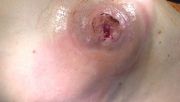 Επεμβάσεις κήλης