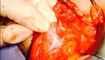 Επεμβάσεις κήλης