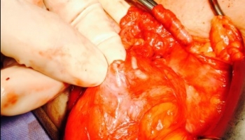 Κλιπς τιτανίου σε κηλικό σάκο