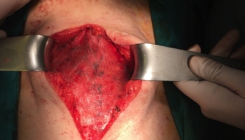 Ομφαλοκήλη και διάσταση μέσης γραμμής