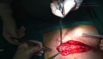 Ομφαλοκήλη και διάσταση μέσης γραμμής