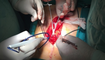 Ομφαλοκήλη και διάσταση μέσης γραμμής