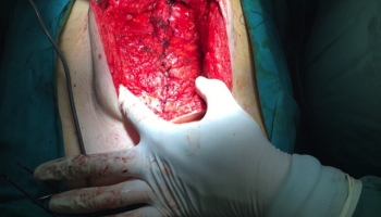 Ομφαλοκήλη και διάσταση μέσης γραμμής