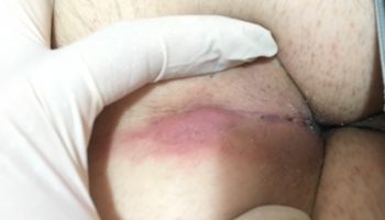 Απόστημα κύστης κόκκυγα