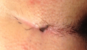 Κύστη κόκκυγος