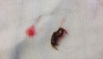 Ανοιχτή αντιμετώπιση κύστης κόκκυγος