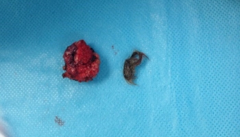 Κύστη κόκκυγος