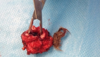 Ανοιχτή αντιμετώπιση κύστης κόκκυγος