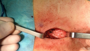 Ανοιχτή αντιμετώπιση κύστης κόκκυγος