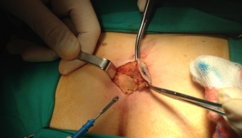 Κλειστή μέθοδος θεραπείας κύστης κόκκυγα