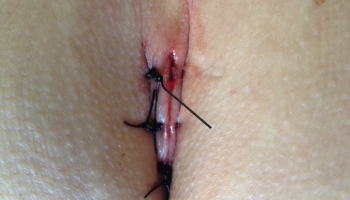 Κλειστή μέθοδος θεραπείας κύστης κόκκυγα