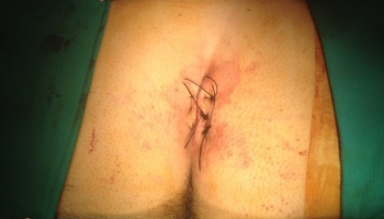 Κλειστή μέθοδος θεραπείας κύστης κόκκυγα