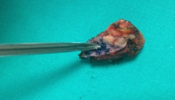 Κλειστή μέθοδος θεραπείας κύστης κόκκυγα