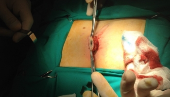 Κλειστή μέθοδος θεραπείας κύστης κόκκυγα