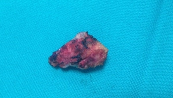 Κλειστή μέθοδος θεραπείας κύστης κόκκυγα