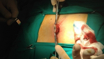 Κλειστή μέθοδος θεραπείας κύστης κόκκυγα