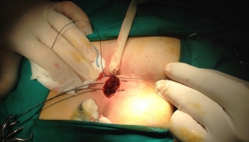 Κλειστή μέθοδος θεραπείας κύστης κόκκυγα