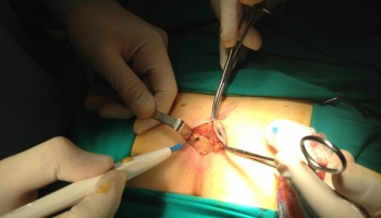 Κλειστή μέθοδος θεραπείας κύστης κόκκυγα