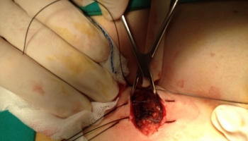 Κλειστή μέθοδος θεραπείας κύστης κόκκυγα