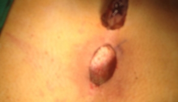 Κλειστή μέθοδος θεραπείας κύστης κόκκυγα