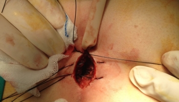 Κύστη κόκκυγος