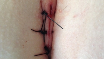 Κλειστή μέθοδος θεραπείας κύστης κόκκυγα