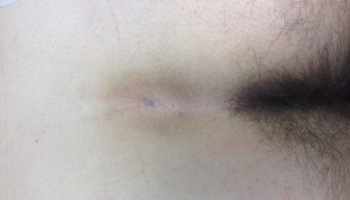 Κλειστή μέθοδος θεραπείας κύστης κόκκυγα