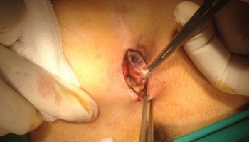 Κλειστή μέθοδος θεραπείας κύστης κόκκυγα