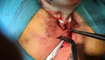 Κύστη κόκκυγα: Ανοιχτή μέθοδος με συριγγοτομή 