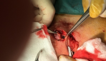 Κύστη κόκκυγα: Ανοιχτή μέθοδος με συριγγοτομή 