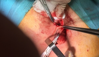 Κύστη κόκκυγα: Ανοιχτή μέθοδος με συριγγοτομή 