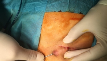 Κύστη κόκκυγα: Ανοιχτή μέθοδος με συριγγοτομή 