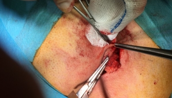 Κύστη κόκκυγα: Ανοιχτή μέθοδος με συριγγοτομή 