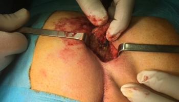 Κύστη κόκκυγα: Ανοιχτή μέθοδος με συριγγοτομή 