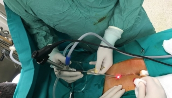 Ενδοσκοπική μέθοδος κύστης κόκκυγα (Epsit)