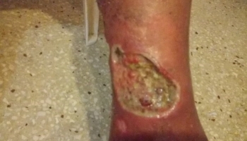 Μικτό έλκος κνήμης