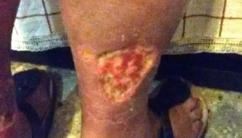 Μικτό έλκος κνήμης