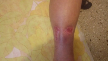 Μικτό έλκος κνήμης