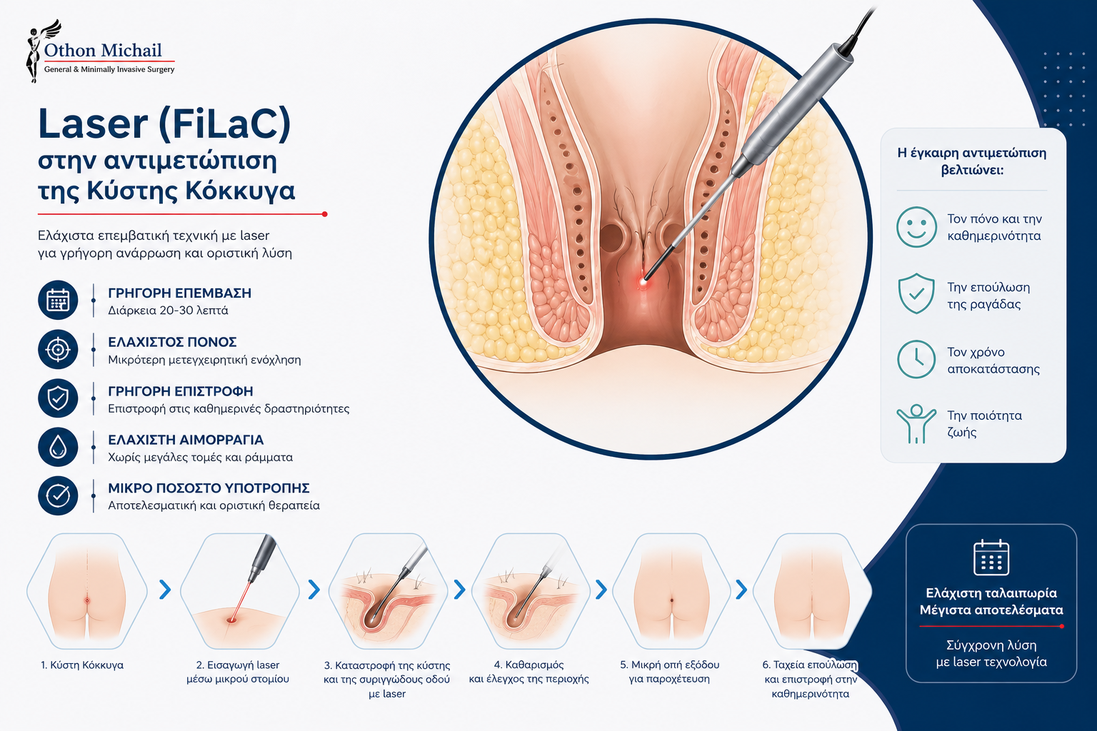 Laser κύστης κόκκυγος FiLaC® – σύγχρονη αναίμακτη θεραπεία τριχοφωλεακού συριγγίου