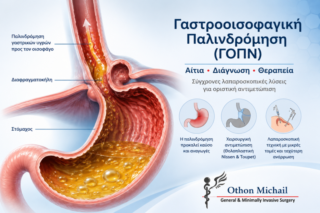 Γαστροοισοφαγική παλινδρόμηση (ΓΟΠΝ) με παλινδρόμηση γαστρικών υγρών στον οισοφάγο