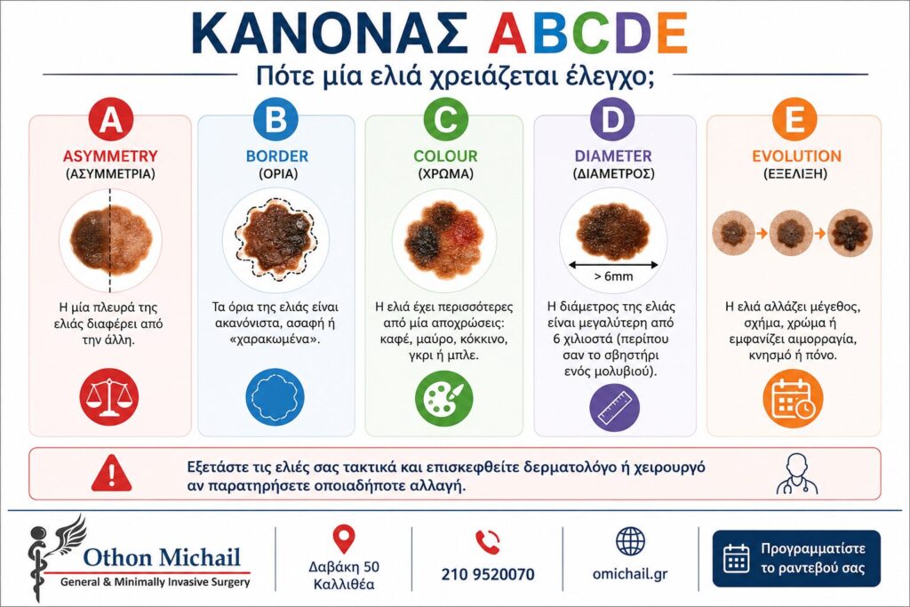 Infographic με τον κανόνα ABCDE για την αναγνώριση ύποπτων σπίλων και επικίνδυνων ελιών.