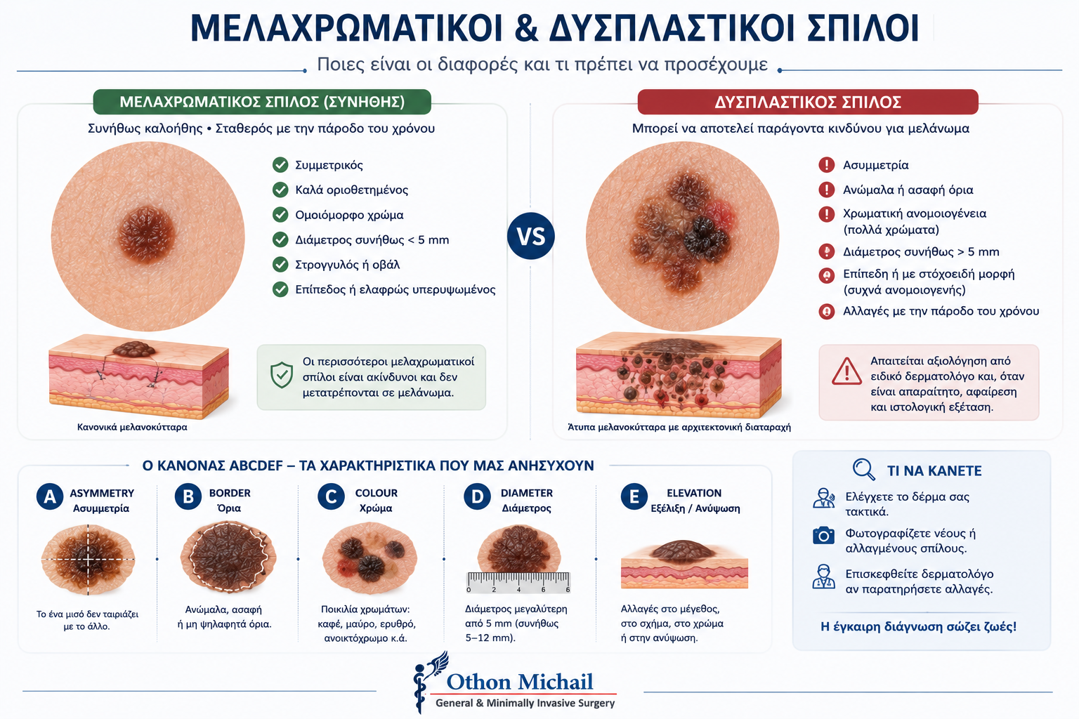 Ιατρική εικονογράφηση που συγκρίνει έναν κοινό μελαχρωματικό σπίλο με έναν δυσπλαστικό σπίλο και παρουσιάζει τα κριτήρια ABCDEF.
