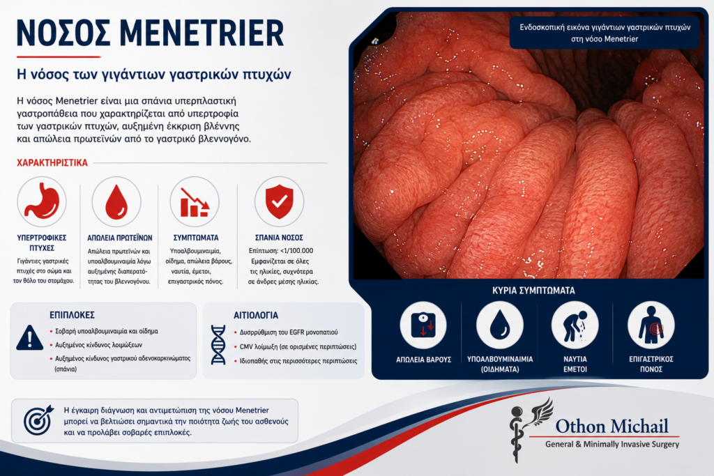Ενδοσκοπική εικόνα νόσου Menetrier με χαρακτηριστικές υπερτροφικές πτυχές