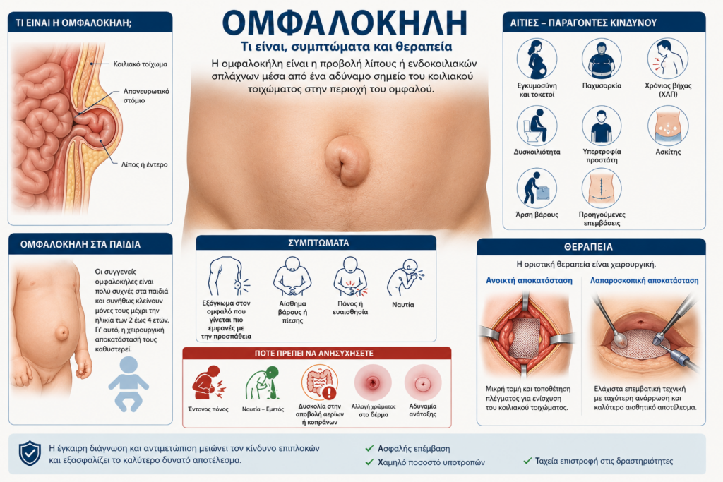 Ιατρικό infographic για την ομφαλοκήλη με ανατομική απεικόνιση, συμπτώματα, διάγνωση και σύγχρονες μεθόδους χειρουργικής αποκατάστασης από τον Dr. Όθωνα Μιχαήλ.