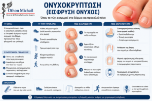 Ιατρικό infographic για την ονυχοκρύπτωση με τα συμπτώματα και τη θεραπεία της.