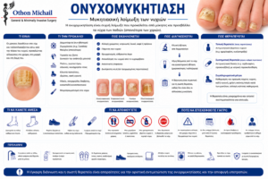 Ιατρικό infographic για την ονυχομυκητίαση με τα συμπτώματα και τις θεραπευτικές επιλογές.