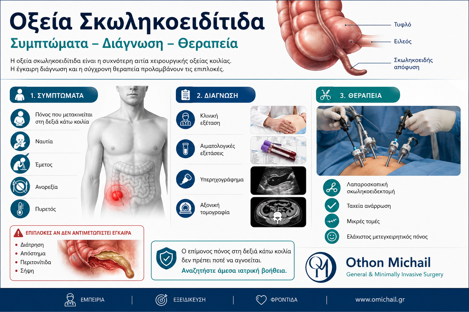 Ιατρικό infographic που παρουσιάζει τα συμπτώματα, τη διάγνωση και τη θεραπεία της οξείας σκωληκοειδίτιδας.