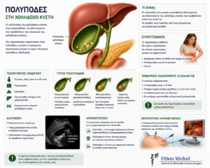 Ιατρικό infographic για τους πολύποδες της χοληδόχου κύστης, την παρακολούθηση και τις ενδείξεις χειρουργείου