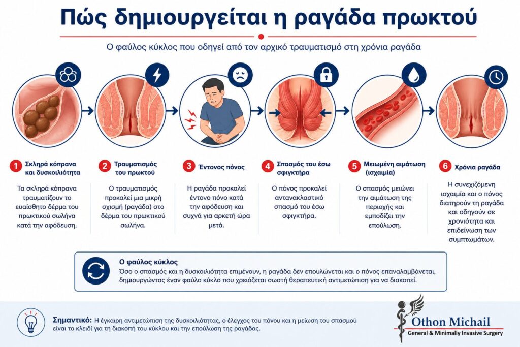 Πώς δημιουργείται η ραγάδα πρωκτού Πώς δημιουργείται η ραγάδα πρωκτού - Infographic που παρουσιάζει τον φαύλο κύκλο από τον τραυματισμό έως τη χρόνια ραγάδα.