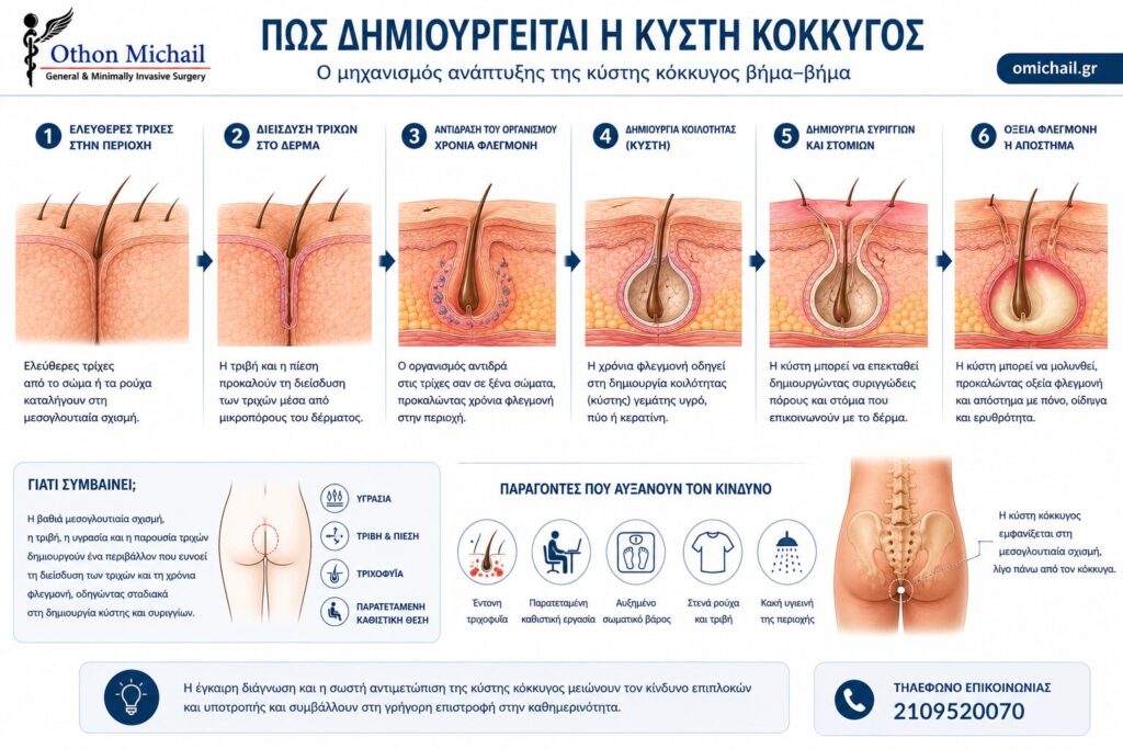 Πώς δημιουργείται η κύστη κόκκυγος Πώς δημιουργείται η κύστη κόκκυγος - Ο μηχανισμός ανάπτυξης βήμα προς βήμα